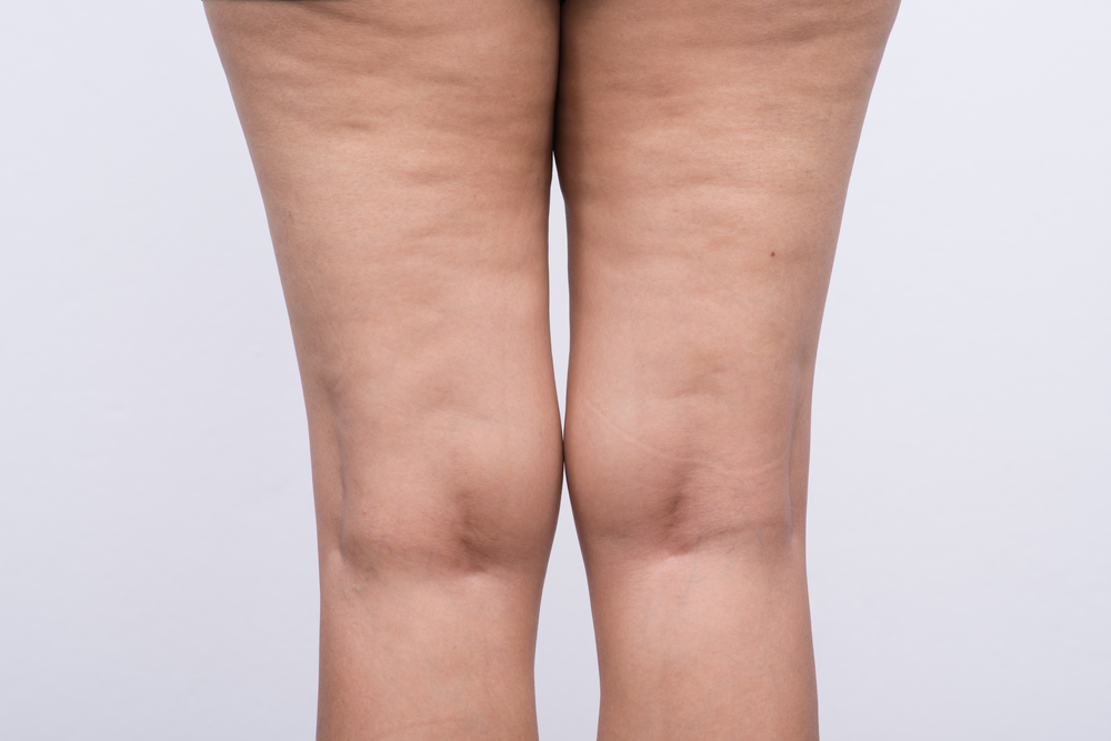 https://www.yourtotalhealthexperience.com/wp-content/uploads/2019/01/Cellulite-on-womans-legs.jpg